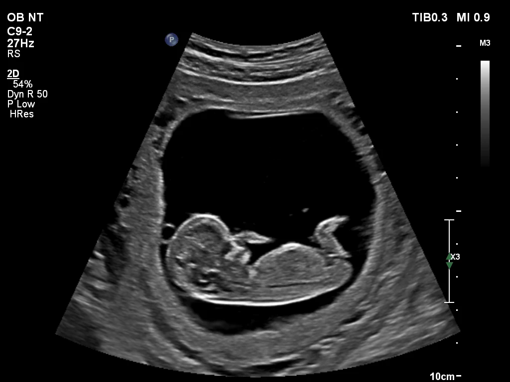 Ultrasound 2d foetus kopie