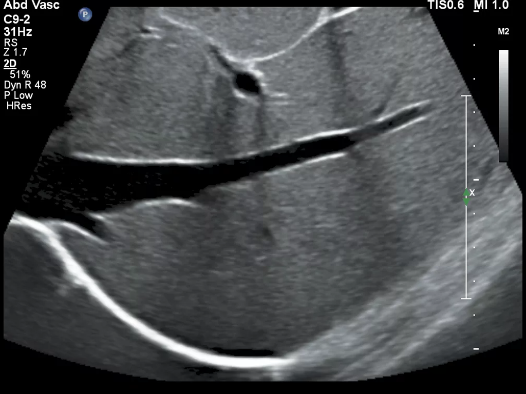 Ultrasound Kidney kopie