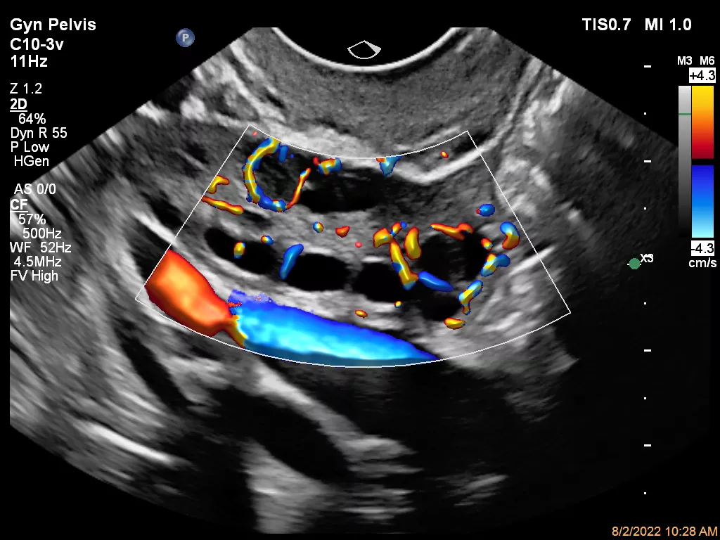 Ultrasound beeld ovary kopie