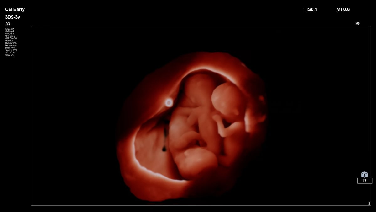 Ultrasound foetus drieling kopie