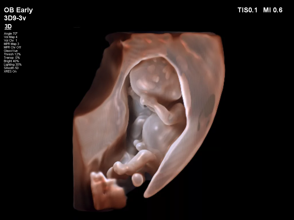 Ultrasound foetus early kopie