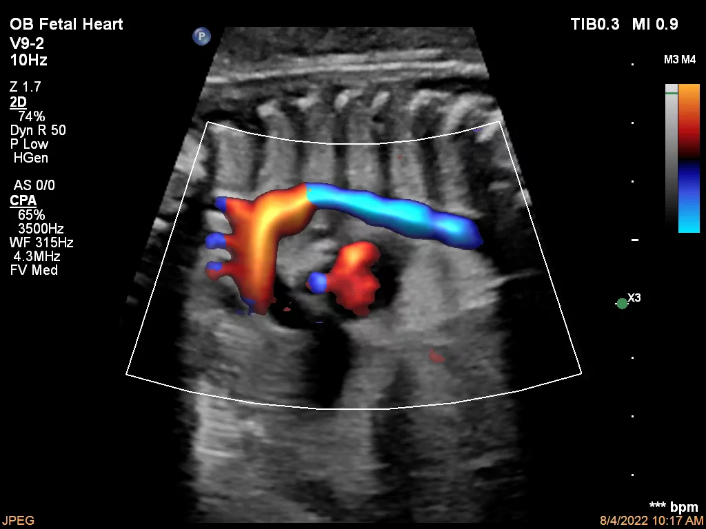 Ultrasound foetus heart kopie