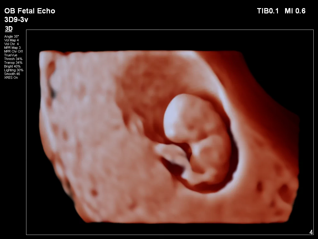 Ultrasound foetus kopie