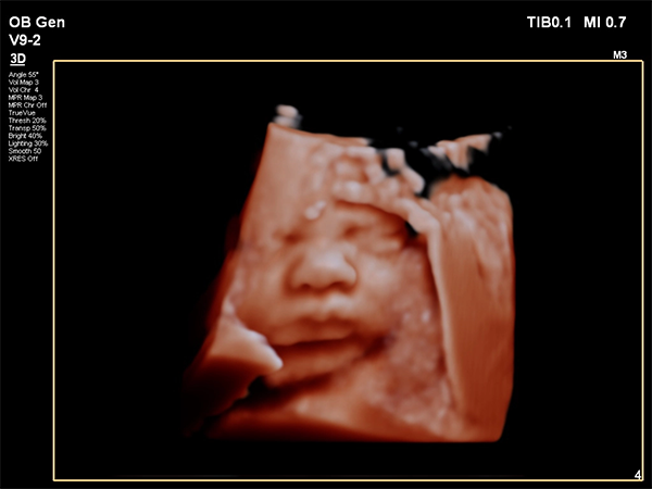 echo beeld affinity 70 gezicht foetus